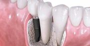 A2Z dental clinic Rockhampton| Emerald Dental clinic| Dental implant